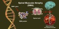 Spinal muscular atrophy, SMA, a genetic neuromuscular disorder with progressive muscle wasting