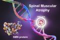 Spinal muscular atrophy, SMA, a genetic neuromuscular disorder with progressive muscle wasting Royalty Free Stock Photo