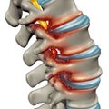 Spinal Stenosis Medical Condition Royalty Free Stock Photo