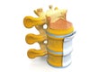 Spinal Stenosis