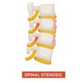 Spinal stenosis spine disease or vertebral illness Royalty Free Stock Photo