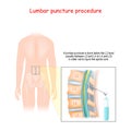 Spinal Tap Procedure. Detailed diagram of lumbar puncture Royalty Free Stock Photo