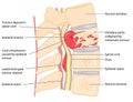 Spinal tumour Royalty Free Stock Photo