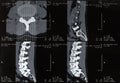 Spinal xray, spine side view Royalty Free Stock Photo