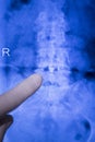 Spine back metal implant xray scan