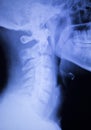 Spine back pain injury xray scan Royalty Free Stock Photo