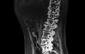 Spine CT Scan showing metastatic tumoral lesions