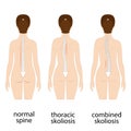 Spine deformation types and healthy spine comparison diagram poster . Royalty Free Stock Photo