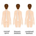 Spine deformation types and healthy spine comparison diagram poster .