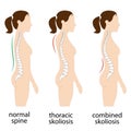 Spine deformation types and healthy spine comparison diagram poster with backbone curvatures.