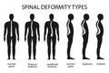 Spine deformity vector illustration. Kyphosis, lordosis spine infographic.