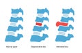 intervertebral hernia concept