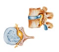Spine - Herniated (Slipped or Ruptured) Disc Royalty Free Stock Photo