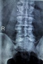 Spine hips Xray test scan Royalty Free Stock Photo