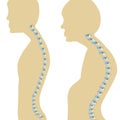 Spine kyphosis. Normal posture and kyphosis. Vector illustration on isolated background Royalty Free Stock Photo