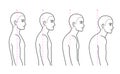 Spine kyphosis progression stages