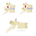 Spine, lumbar vertebra. Facet syndrome, advanced uncovertebral a