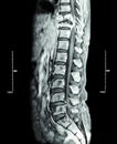 Spine metastasis ( cancer spread to thoracic spine )