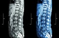 Spine metastasis ( cancer spread to thoracic spine