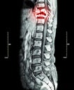 Spine metastasis ( cancer spread to thoracic spine ) ( MRI of thoracic and lumbar spine : show thoracic spine metastasis and compr Royalty Free Stock Photo
