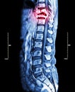 Spine metastasis ( cancer spread to thoracic spine ) ( MRI of thoracic and lumbar spine : show thoracic spine metastasis and compr Royalty Free Stock Photo