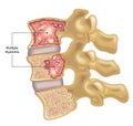 Spine with multiple myeloma