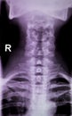 Spine neck Xray test scan Royalty Free Stock Photo