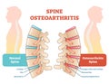 Spine osteoarthritis anatomical vector illustration diagram Royalty Free Stock Photo