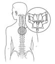 Osteochondrosis scheme. Spine with osteoarthritis elements