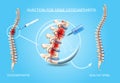 Spine Osteoarthritis Medical Treatment Vector