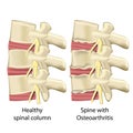 Spine with osteoarthritis ,spinal column medical vector illustration isolated on white background