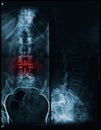 Spine and pelvis of a human body x-ray - red painful area Royalty Free Stock Photo