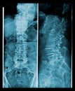 Spine and pelvis of a human body x-ray. Royalty Free Stock Photo