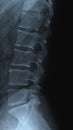 Spine radiograph Royalty Free Stock Photo