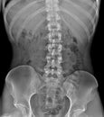 Spine radiography of a hospital patient