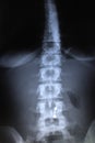 Spine Radiography - X Rays