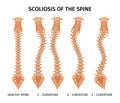 Spine Scoliosis Anatomy Infographics