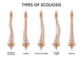 Spine Scoliosis Realistic Set Royalty Free Stock Photo