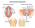 Spine surgery comparison shows open vs minimally invasive methods, highlighting ... Royalty Free Stock Photo