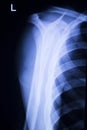 Spine vertebra ribs back injury xray scan Royalty Free Stock Photo