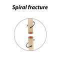 Spiral Bone Fracture. Infographics. Vector illustration on a lined background. Royalty Free Stock Photo