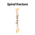 Spiral Bone Fracture. Infographics. Vector illustration on a lined background. Royalty Free Stock Photo