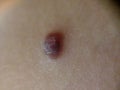 Spitz Nevus on a child a weird mole that was cut