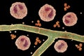 Splendore-Hoeppli phenomenon, 3D illustration. Eosinophilic reaction around the invading fungal hyphae in human tissues