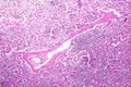 Splenic arterioles hyalinization Royalty Free Stock Photo