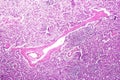 Splenic arterioles hyalinization