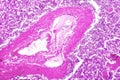 Splenic arterioles hyalinization