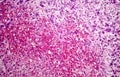 Splenic infarction, photo under microscope Royalty Free Stock Photo
