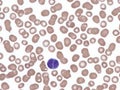 Splenic marginal lymphoma with circulating binucleated lymphocytes. Royalty Free Stock Photo
