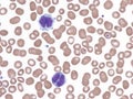 Splenic marginal lymphoma with circulating binucleated lymphocytes. Royalty Free Stock Photo